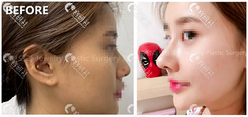 韩国珠儿丽整形外科驼峰鼻矫正案例对比图