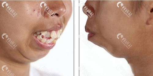 龅牙矫正后脸型变化图图片
