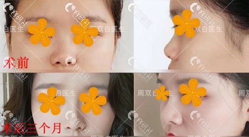 上海九院周双白隆鼻术前术后对比