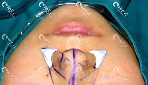 鼻基底凹陷填充位置示意图