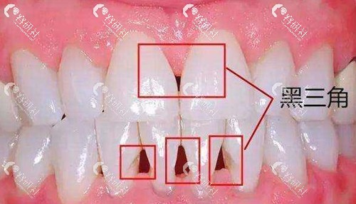 牙齿出现黑三角怎么办