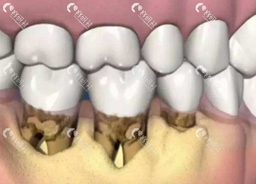 牙结石堆积导致牙龈萎缩