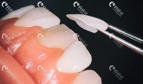 牙贴面可以维持多长时间