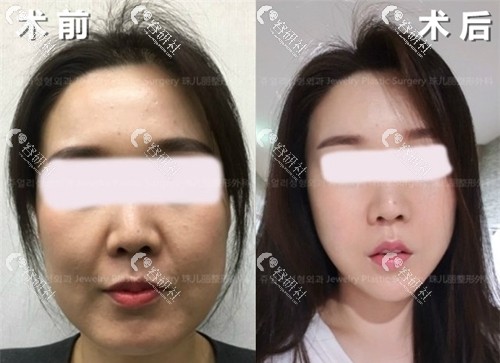 韩国珠儿丽做面部轮廓术前术后对比