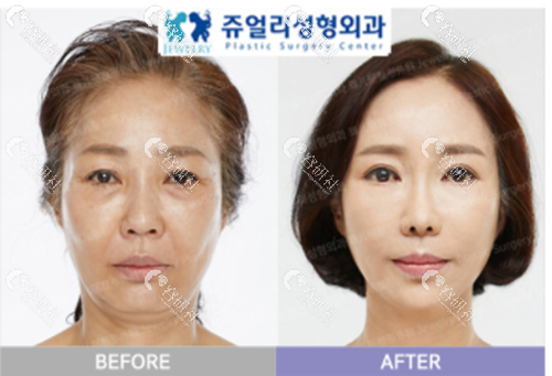 韩国珠儿丽拉皮手术案例