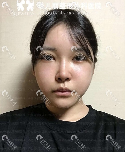 韩国珠儿丽眼鼻手术术后