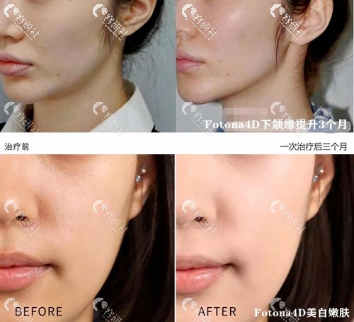 Fotona4D改善下颌缘/提升肤色前后对比图