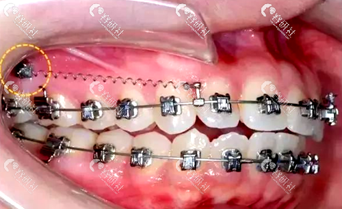 牙齿前突龅牙要打固定（骨钉）吗？