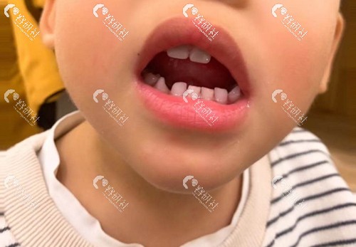 孩子牙齿不齐怎么矫正