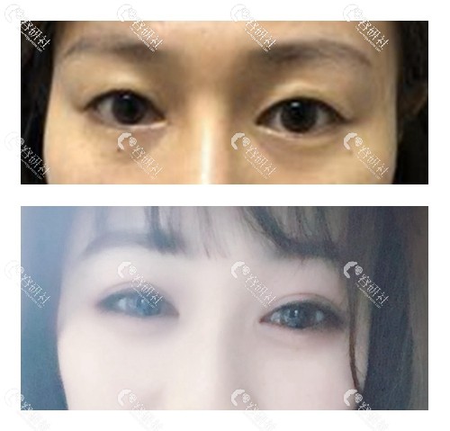深圳美诗沁医疗美容割双眼皮术后照片