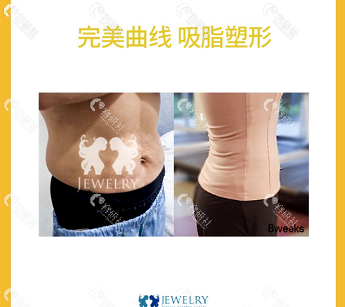 韩国珠儿丽整形外科医院吸脂瘦腰腹案例