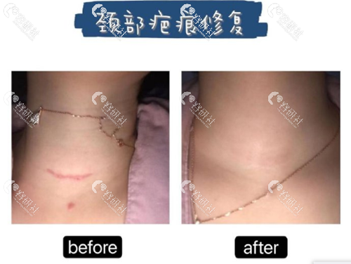 上海清沁医疗美容门诊部疤痕修复日记