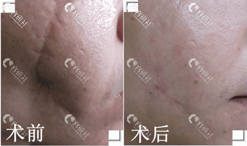 上海江城医疗美容医院疤痕修复日记