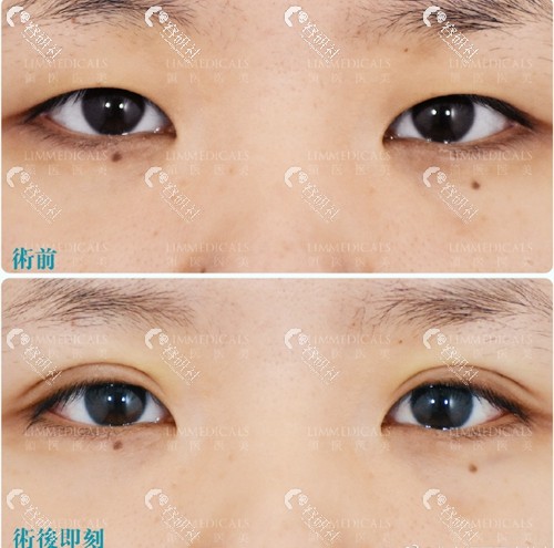 北京领医双眼皮手术案例