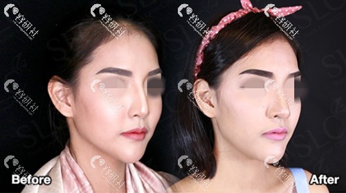 泰国SLC整形外科鼻修复案例