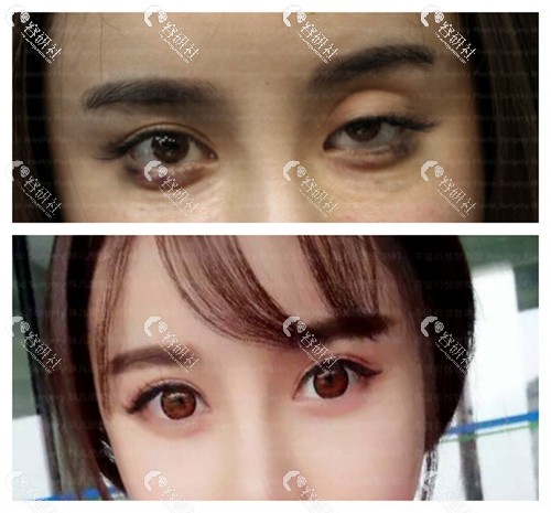 韩国朱文丽医院八次双眼皮修复后案例对比
