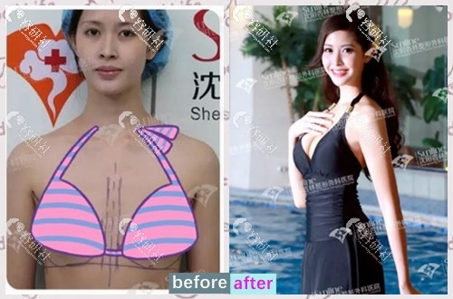 泰国选美皇后兰斯蛮在沈阳杏林假体隆胸对比照