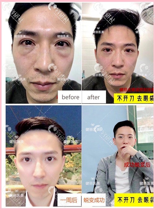 广州健丽医美男士去眼袋日记对比图