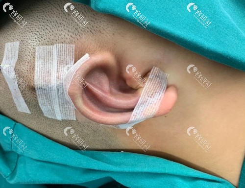 耳再造手术术后