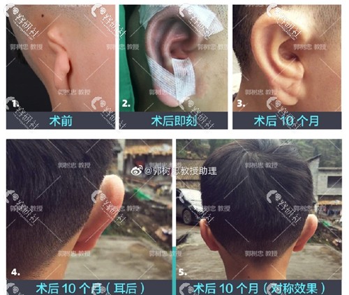 郭树忠教授耳再造术前术后对比