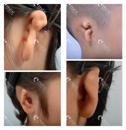先天性耳畸形分类