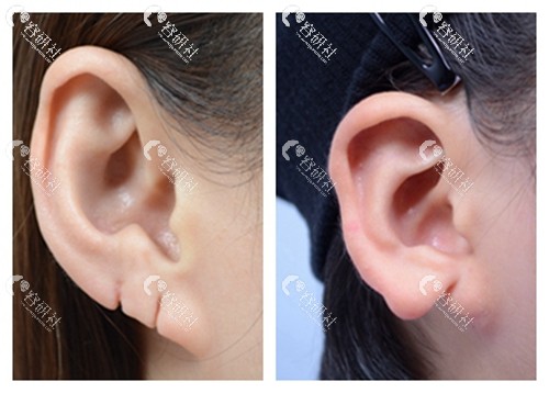 耳廓缺损修复
