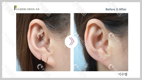 耳廓缺损修复后效果