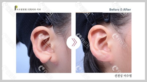 耳廓缺损修复手术案例