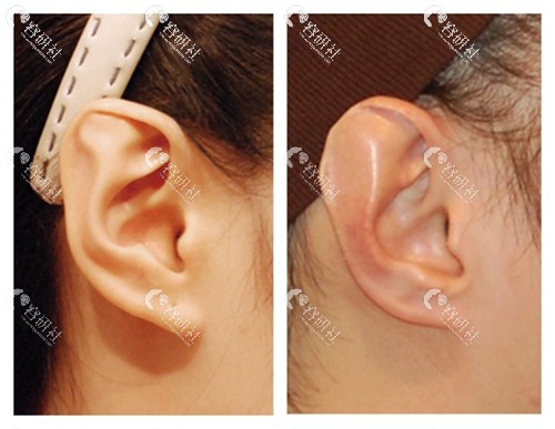 耳廓外凸可以通过手术矫正吗