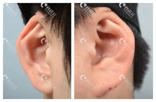 耳廓畸形可以矫正吗