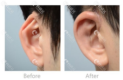耳廓畸形矫正案例