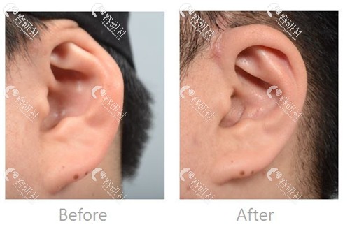 耳廓畸形矫正效果照片