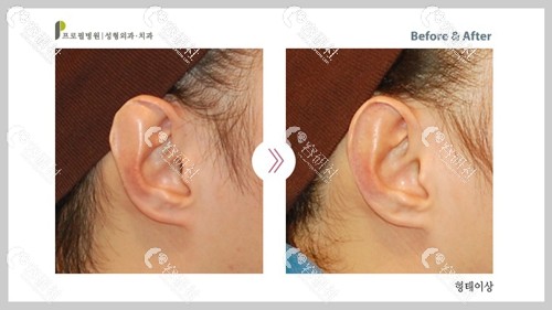 韩国profile普罗菲耳耳朵向外翻矫正手术案例
