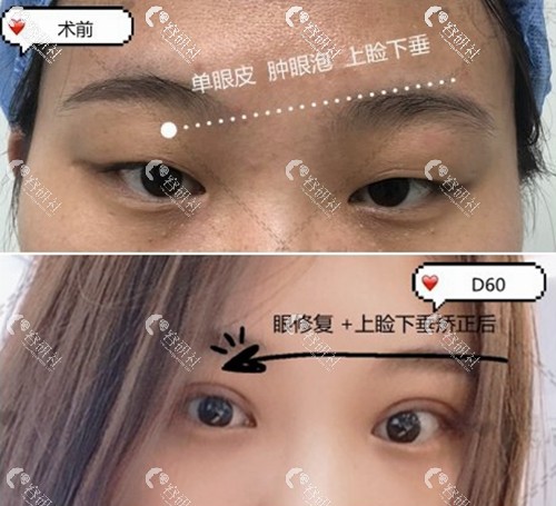 北京丽星翼美魏志香双眼皮修复术前术后对比