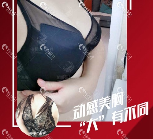 北京丽都假体隆胸案例