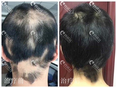 斑秃治疗方法 长春岳氏植发日记 斑秃治疗日记