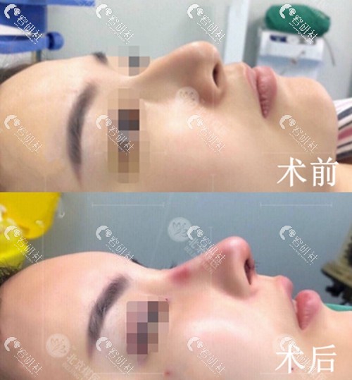 北京煤医隆鼻术前术后即刻对比