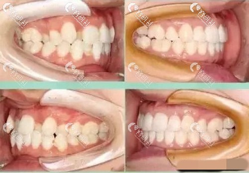 珠海九龙口腔医院牙齿矫正案例