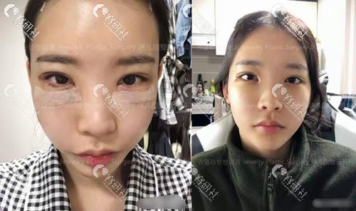 在韩国珠儿丽做双眼皮术后半个月