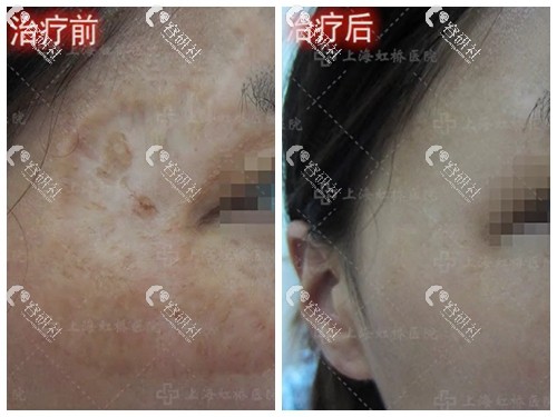 上海虹桥医院挛缩疤痕修复前后对比照片