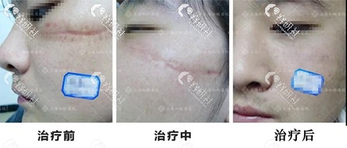 上海虹桥医院凹陷性疤痕前后对比照