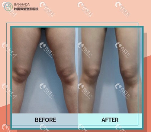 韩国微塑整形医院吸脂瘦小腿真实案例