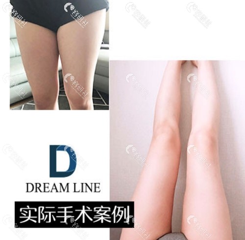 韩国梦线Dreamline整形医院吸脂瘦小腿案例