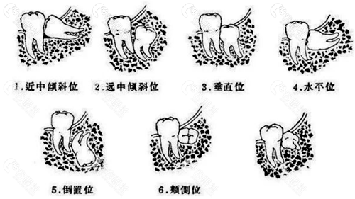 不同智齿生长的情况展示图