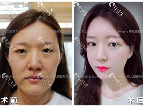 韩国珠儿丽医院下颌角磨骨案例对比图