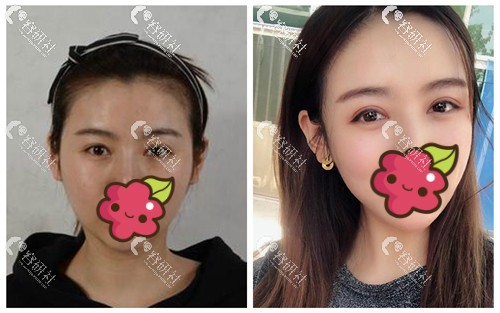北京美莱医疗美容医院双眼皮手术日记