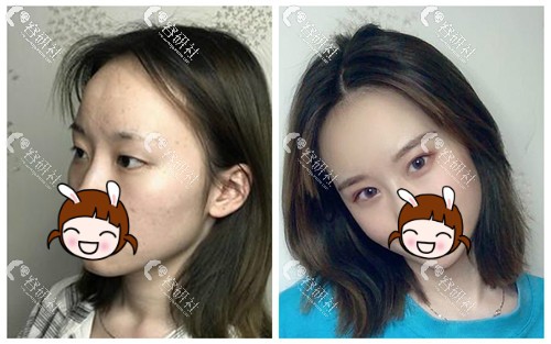 杭州薇琳医疗美容医院双眼皮手术日记
