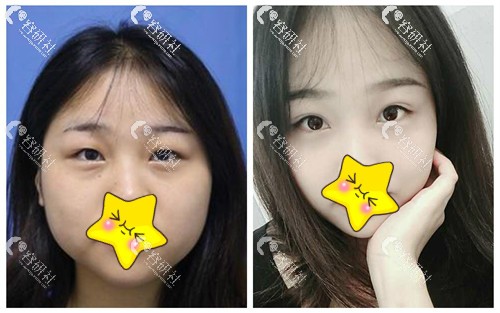 深圳健丽医疗美容门诊部双眼皮手术日记