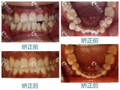 广州中家医家庭医生口腔医院牙齿矫正日记