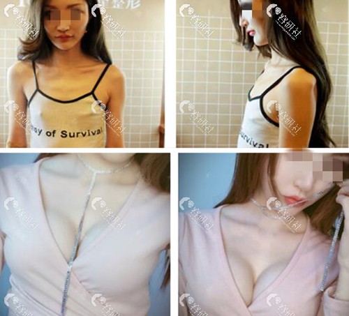上海艺星丰胸手术多少钱？